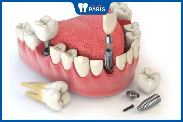 Chi phí trồng răng phụ thuộc vào số lượng răng cần phục hình