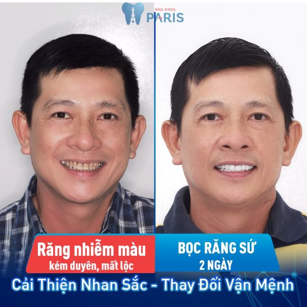 Paris – Nha khoa chuyên sâu thẩm mỹ răng sứ cho Việt kiều