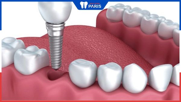 Nhổ răng bao lâu thì có thể cấy Implant? Các giai đoạn trồng răng