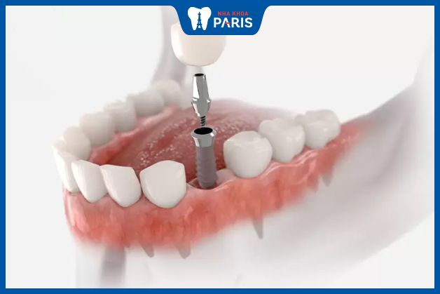 Trồng răng Implant ngăn chặn hóp má sau khi nhổ răng