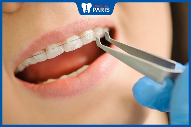 Quy trình niềng răng tại Nha khoa Paris