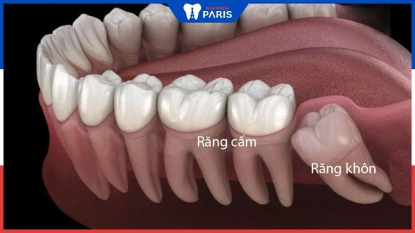 So sánh răng cấm và răng khôn, 5 điểm khác biệt