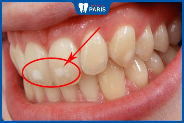 Răng bị nhiễm fluor
