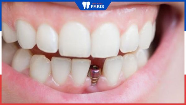 Trồng răng cửa kiêng ăn gì? Chăm sóc răng miệng khi trồng răng