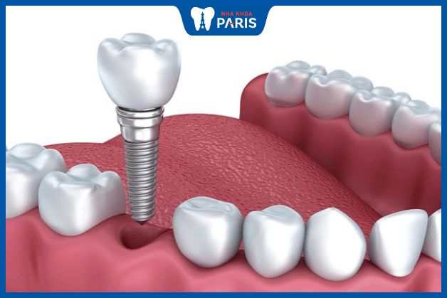 Trồng răng Implant có chi phí cao nhất do ngăn chặn được tiêu xương