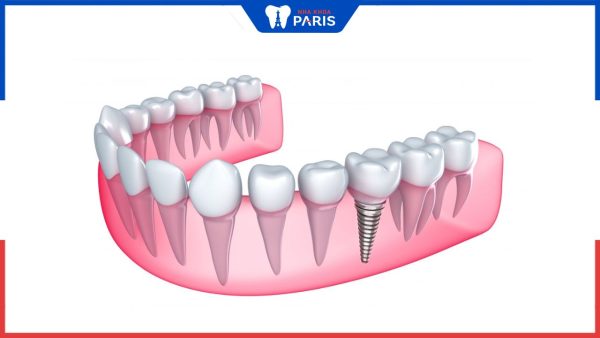 Trồng răng Implant có ảnh hưởng gì không? Một số biến chứng
