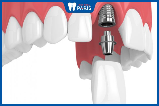 Trồng răng Implant cho răng cửa