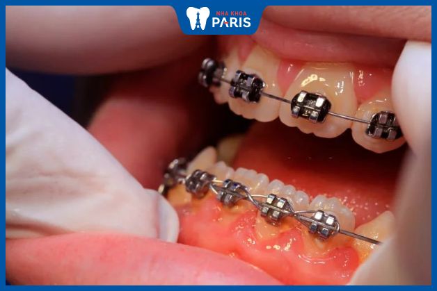 Người bệnh viêm nha chu nhẹ vẫn có thể niềng răng