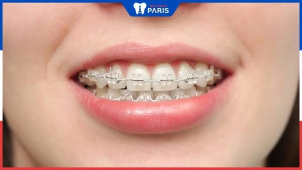 Viêm khớp thái dương hàm có nên niềng răng không: Bác sĩ tư vấn