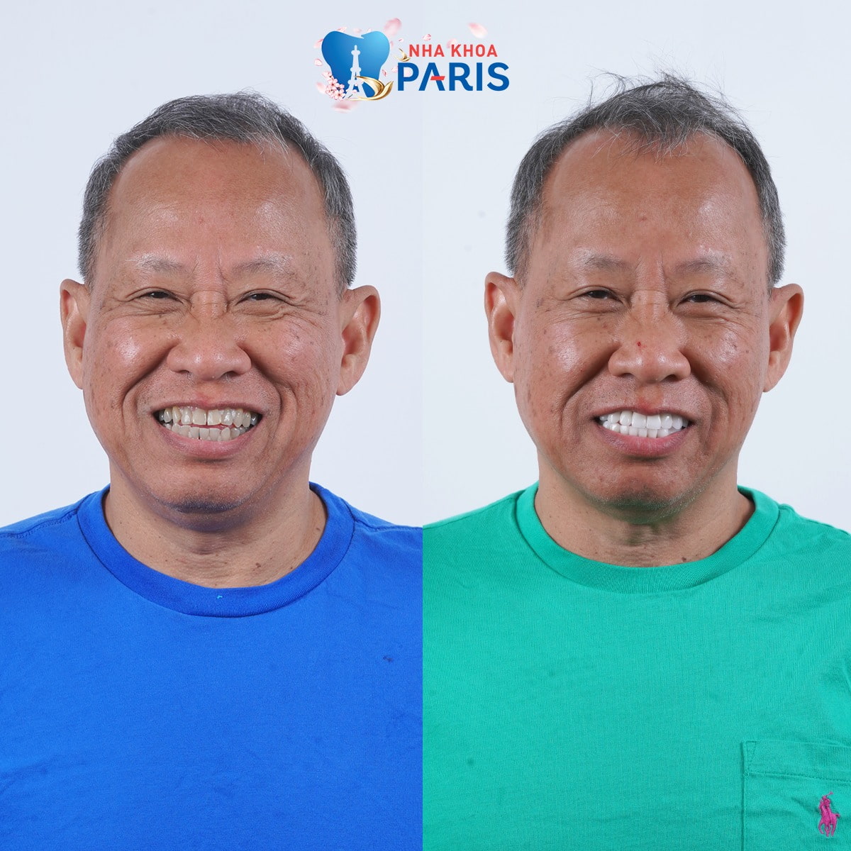 Việt kiều Mỹ làm răng tại Nha Khoa Paris