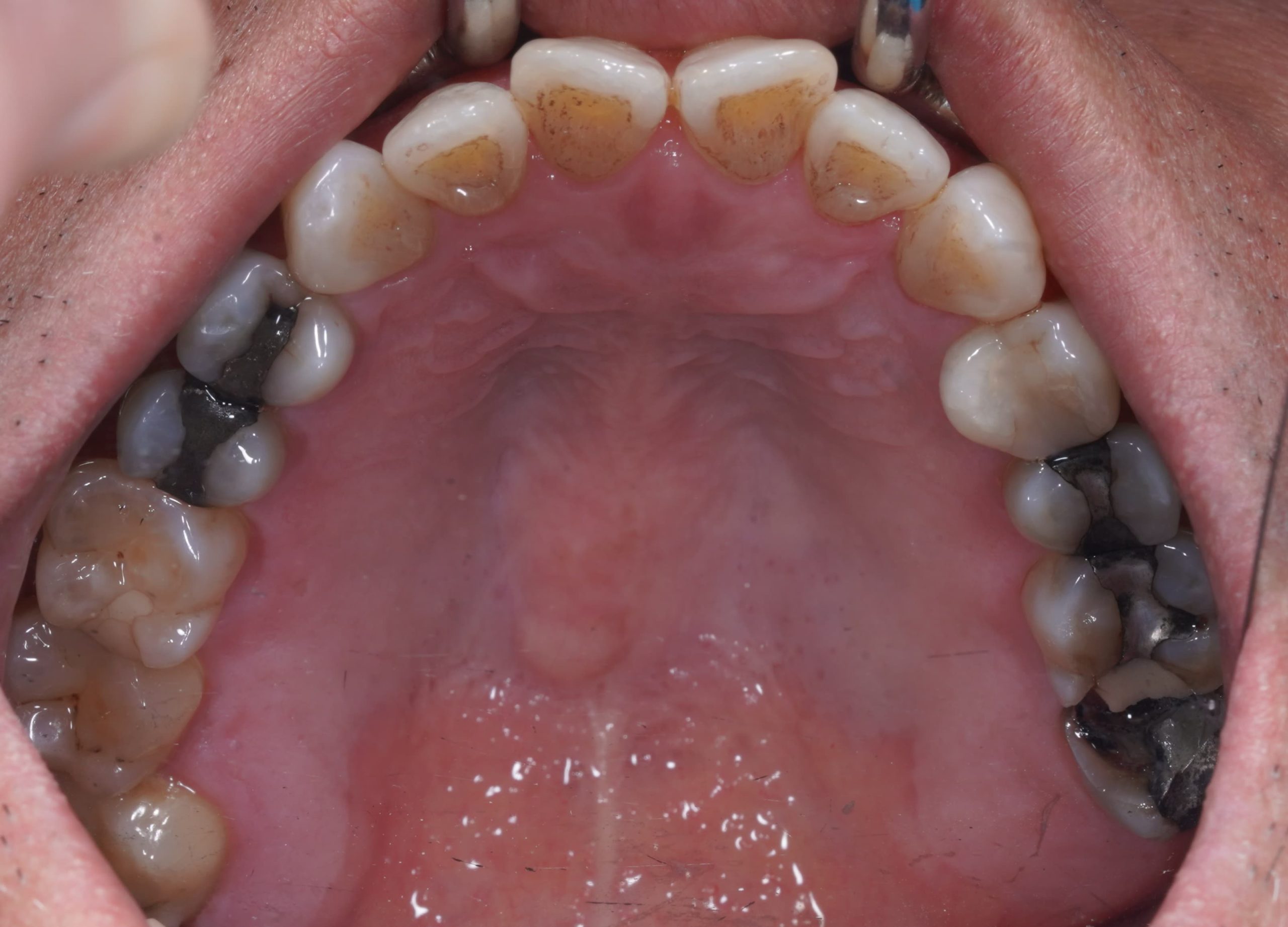 Tình trạng trước khi làm răng