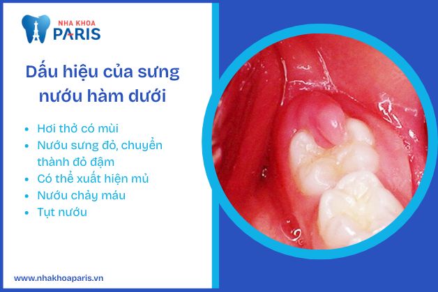 Dấu hiệu của sưng nướu hàm dưới