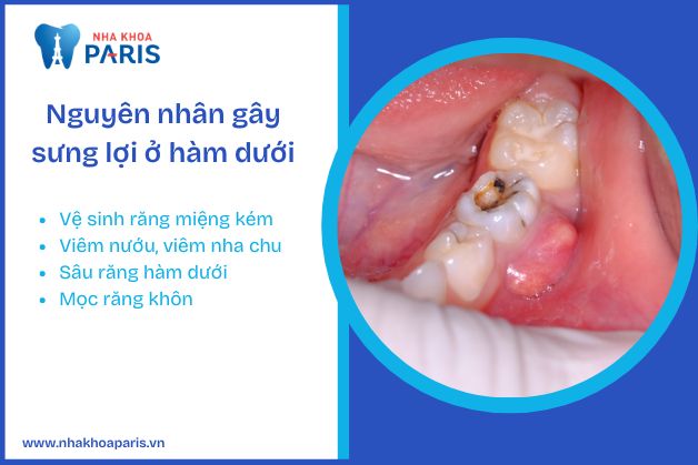 Nguyên nhân gây sưng lợi ở hàm dưới