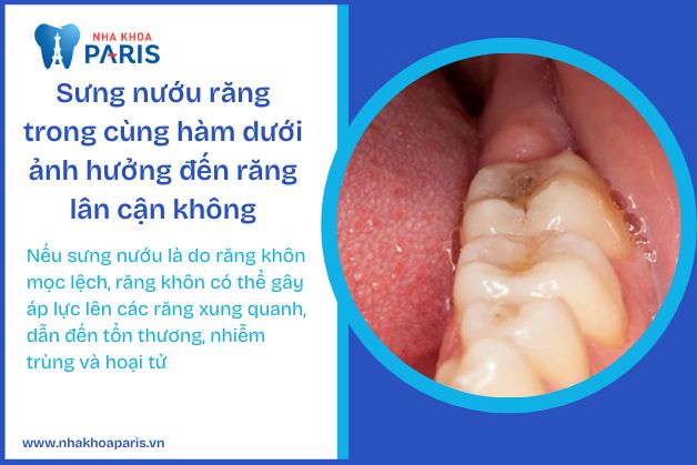 Sưng nướu răng trong cùng hàm dưới ảnh hưởng đến răng lân cận