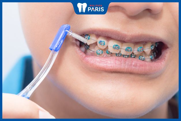 Bàn chải kẽ răng giúp vệ sinh răng miệng dễ dàng hơn