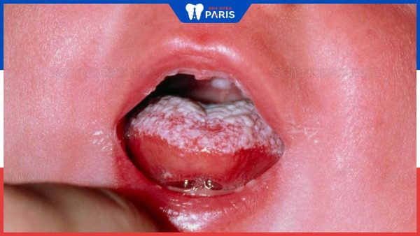 Bé bị rộp trắng trong miệng là bị bệnh gì? Biện pháp ngăn ngừa