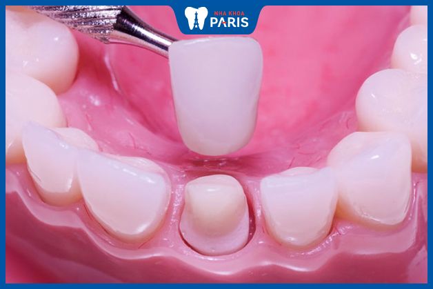 Răng sứ toàn sứ sẽ có tuổi thọ cao hơn răng sứ kim loại