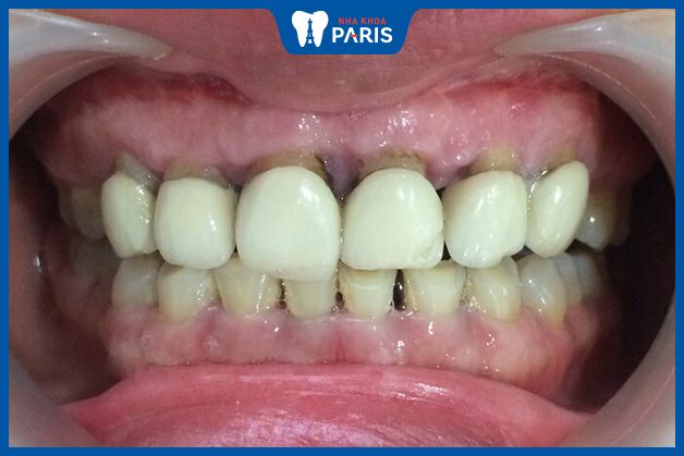 Răng sứ đổi màu, bề mặt nhám, mẻ vỡ là dấu hiệu răng sứ bị mòn