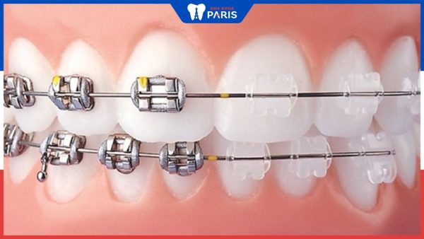 Các loại niềng răng phổ biến hiện nay có thể bạn chưa biết