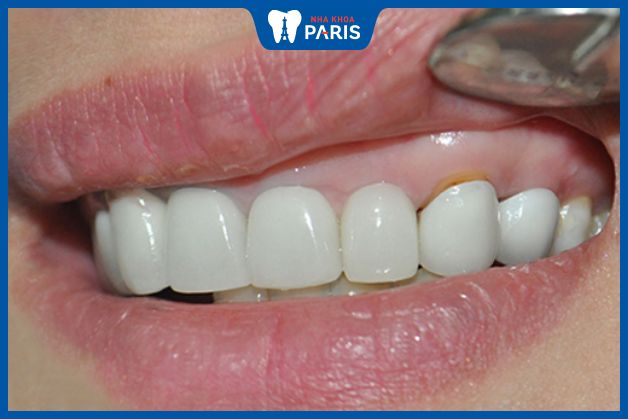 Kẽ hở giữa nướu và răng có thể bị sâu nếu không được vệ sinh đúng cách