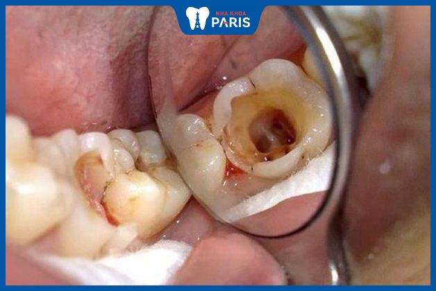 Sâu răng là một trong những nguyên nhân hàng đầu gây đau nhức, ê buốt