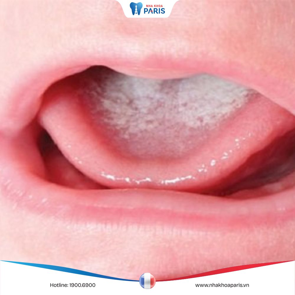 Cách điều trị bệnh nấm lưỡi ở trẻ em an toàn và triệt để