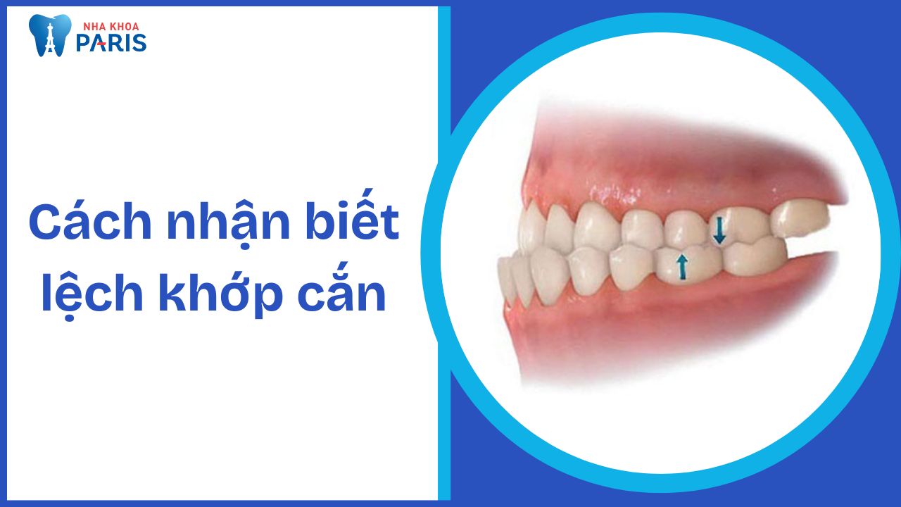 Cách nhận biết lệch khớp cắn và những điều cần biết về điều trị
