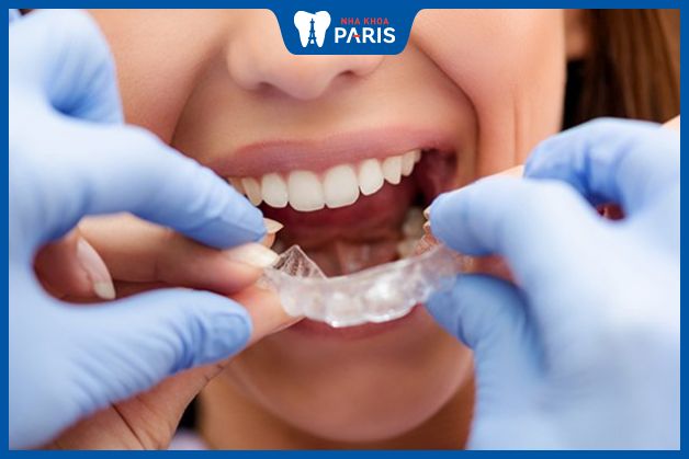 Máng chống nghiến răng được nhiều nha sĩ khuyên dùng