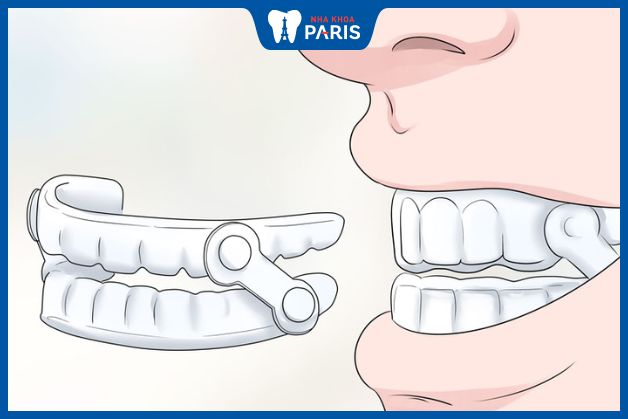 Cần nắm được cách đeo máng chống nghiến răng chuẩn để đảm bảo hiệu quả sử dụng