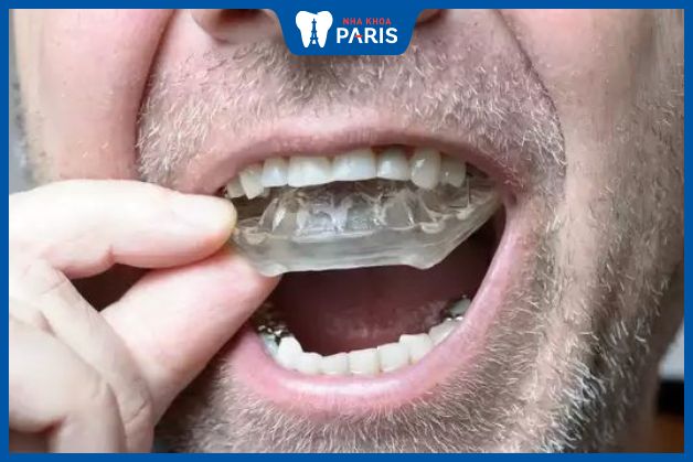 Cần bảo quản máng chống nghiến răng sau khi sử dụng để nâng cao tuổi thọ và tránh các bệnh răng miệng