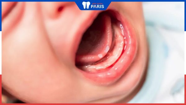 Những cách trị nhiệt miệng cho trẻ sơ sinh an toàn và hiệu quả