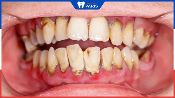 Cao răng là gì? hình thành thế nào – Cách làm sạch cao răng