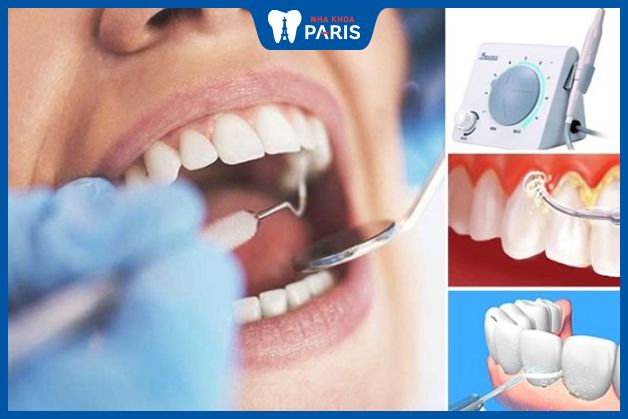 Sử dụng dụng cụ chuyên dụng để đánh bật mảng bám ra khỏi bề mặt răng