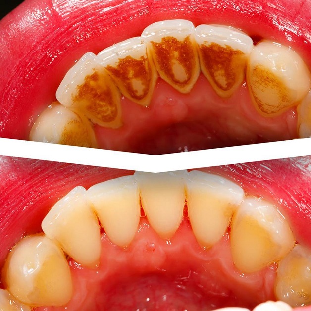 Kết quả cạo vôi răng bằng công nghệ Cavitron BP 8.0