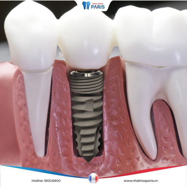 Cấy ghép Implant – Phục hồi hoàn hảo cho răng thật 100%