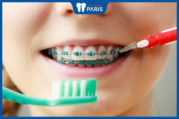 Chăm sóc răng miệng đúng cách giúp đảm bảo hiệu quả niềng răng