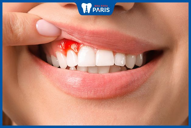 Viêm lợi là một trong những nguyên nhân gây chảy máu chân răng