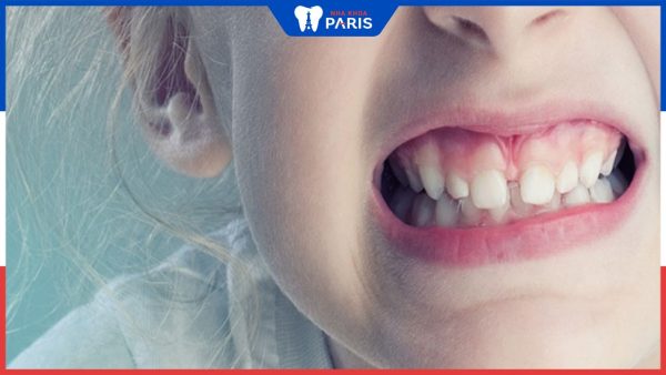 Chữa nghiến răng ở trẻ em nhanh chóng và an toàn bạn nên biết