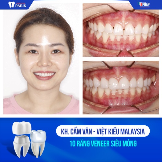 Khách hàng Cẩm Vân trải nghiệm dịch vụ dán 10 răng sứ Veneer