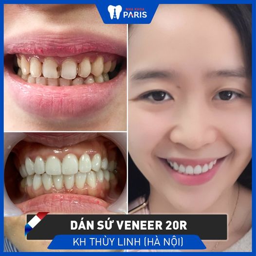 Khách hàng Thuỳ Linh sử dụng dịch vụ dán sứ Veneer cho 20 răng