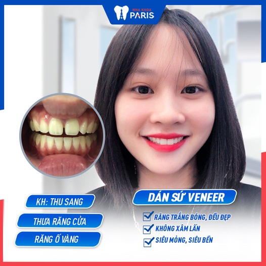 Khách hàng Thu Sang vui mừng vì các nhược điểm trên hàm răng được khắc phục sau khi dán sứ Veneer