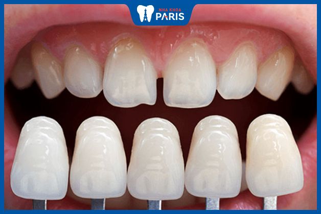 Chi phí dán sứ còn phụ thuộc số lượng răng cần phục hình