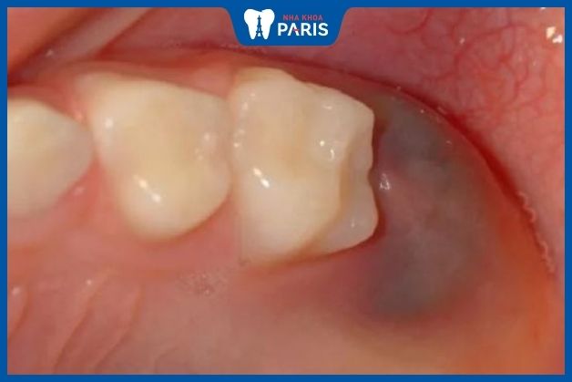Biến chứng nhiễm trùng sau khi nhổ răng 