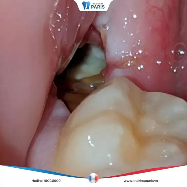 12 Dấu hiệu nhiễm trùng sau khi nhổ răng và cách xử lý dứt điểm