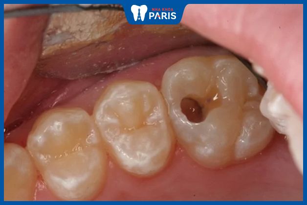 Dấu hiệu nhận biết răng trong cùng bị sâu