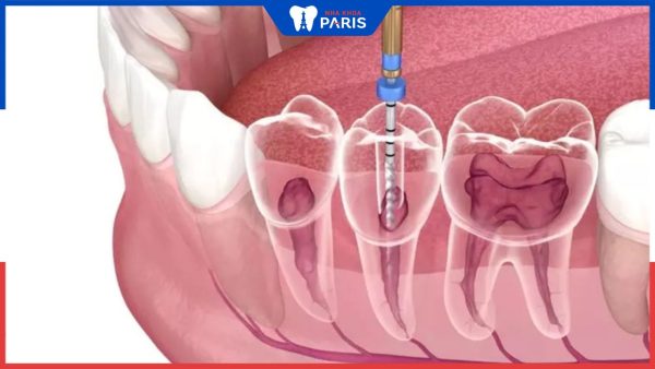 Điều trị tủy răng mất bao lâu? Quy trình điều trị tủy răng