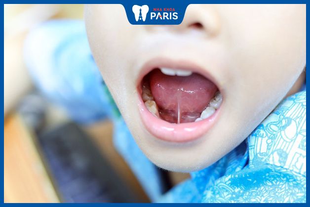 Dây thắng lưỡi ngắn gây ảnh hưởng đến khả năng phát âm của trẻ