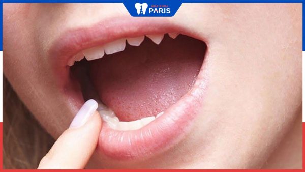 Hiện tượng rát lưỡi là bệnh gì? nguyên nhân và cách điều trị