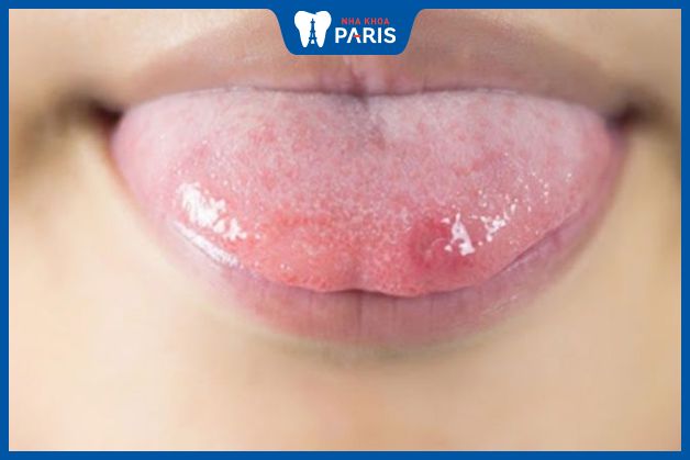 Có thể xuất hiện ở bất kỳ vị trí nào trong miệng, nhưng thường gặp nhất ở lưỡi, má trong, môi trong và vòm miệng.