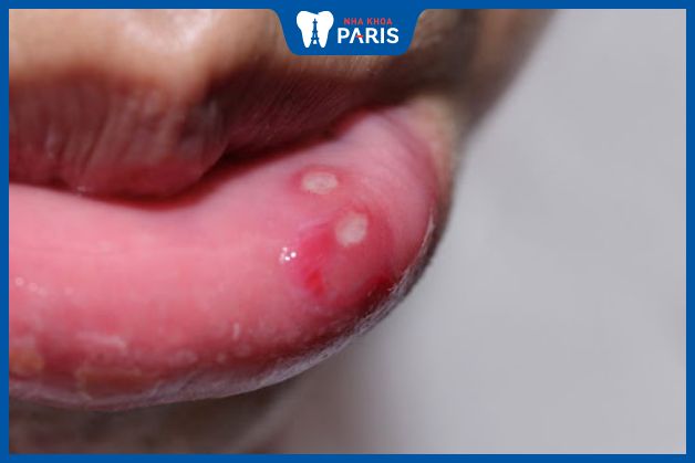 Vết nhiệt miệng có thể gây xót cho người bệnh, đặc biệt khi ăn uống, nói chuyện hoặc đánh răng